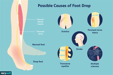 how to evaluate foot drop